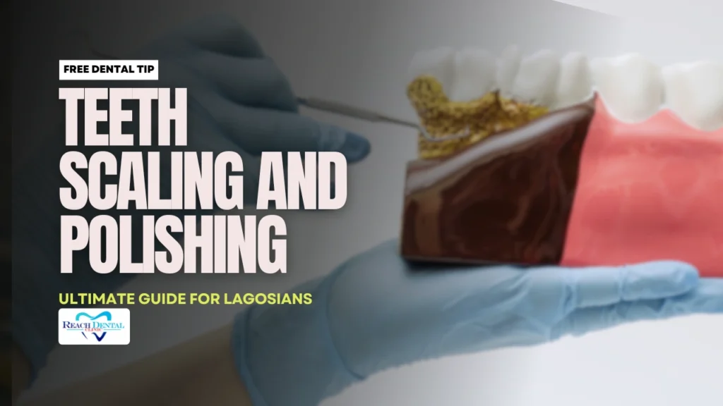 Teeth Scaling and Polishing