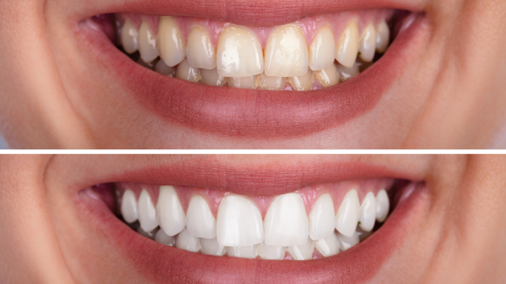 teeth whitening in lagos