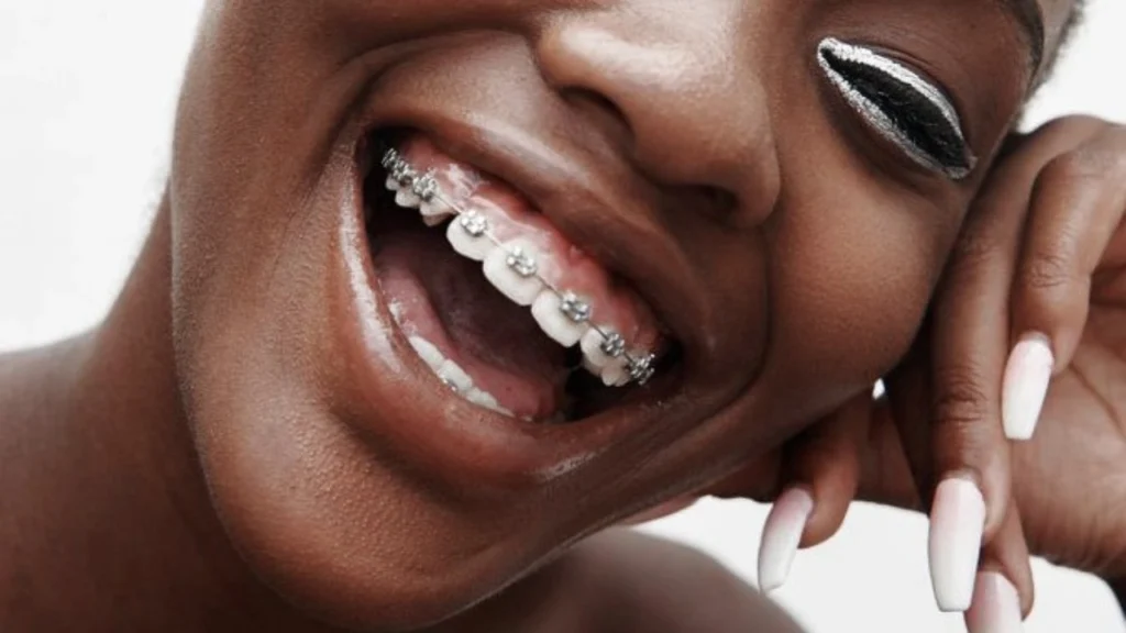 Traditional Metal Braces in Lagos