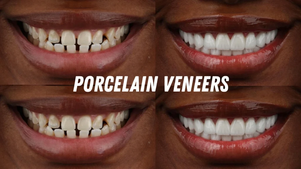 Porcelain Veneers Before and After