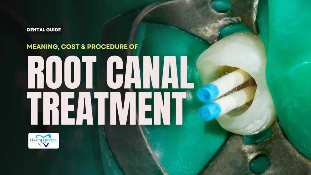 root canal treatment