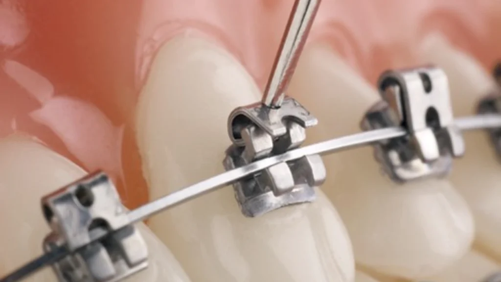 Self Ligating Braces