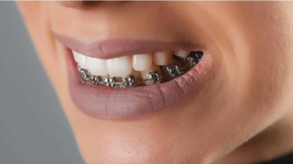 Single Arch Braces

