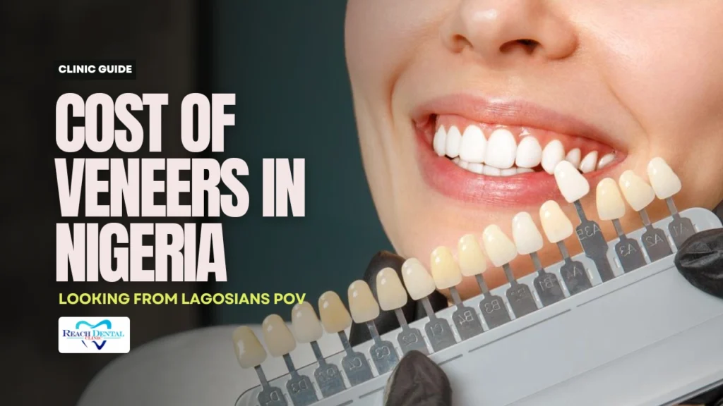 Veneer cost in Nigeria