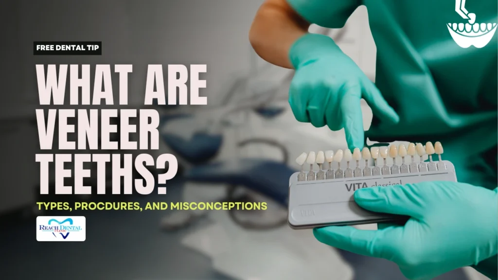 What are veneer teeth