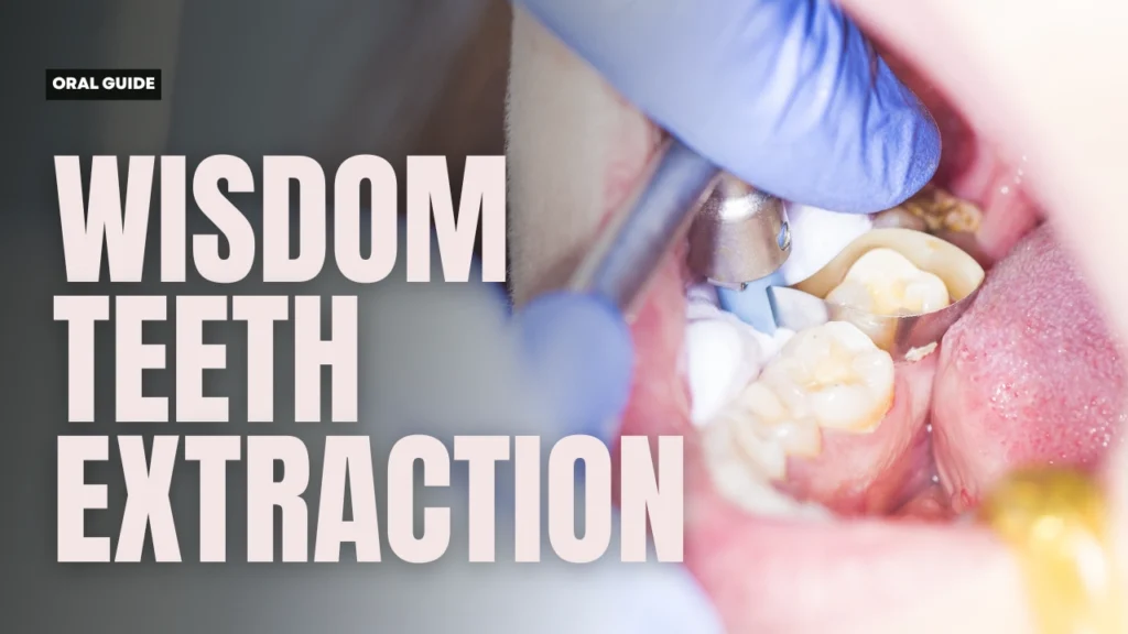 Wisdom Teeth Extraction