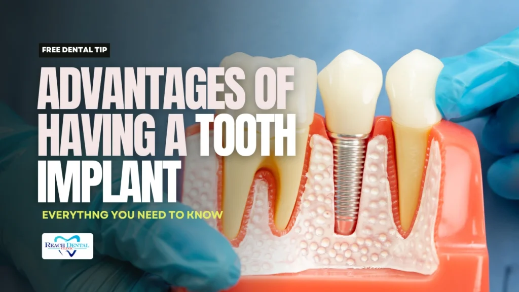 advantages of having tooth implant