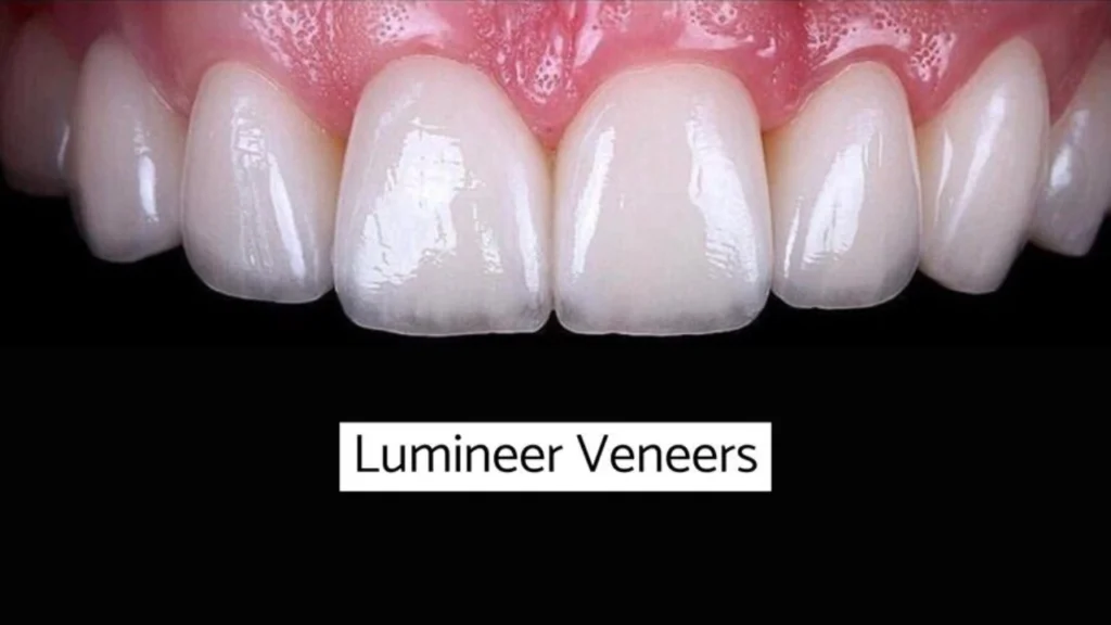What are veneer teeth