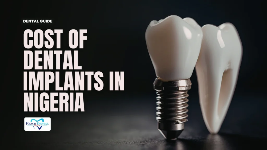 Cost of Dental Implant