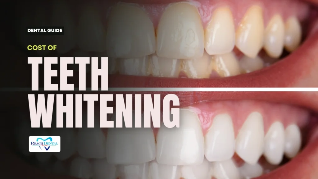 Teeth Whitening