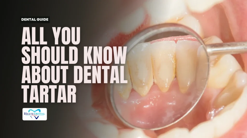 dental tartar