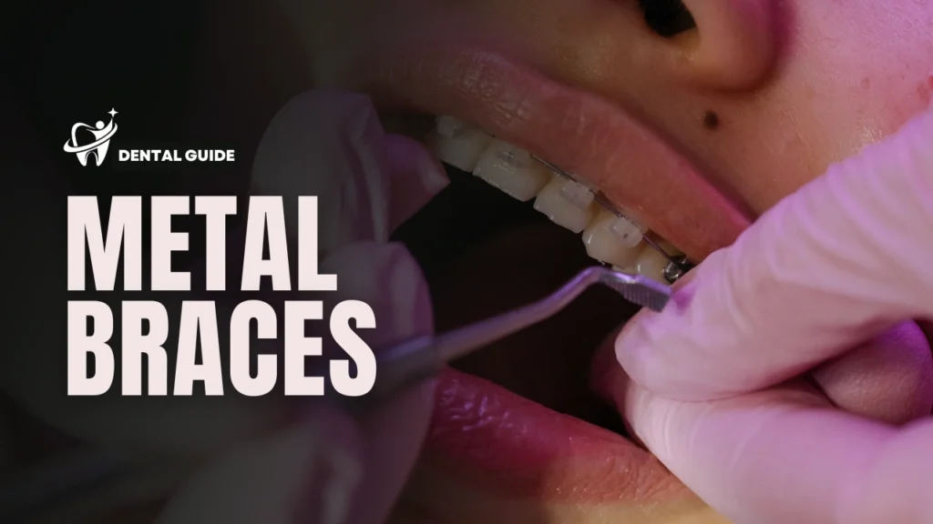 Metal Braces
