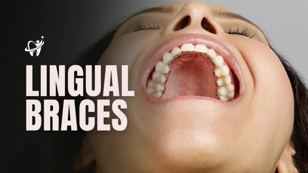 What are Lingual Braces