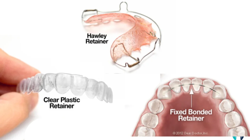 What Are Dental Retainers? Types and How to Clean Them - Dr. Reach ...